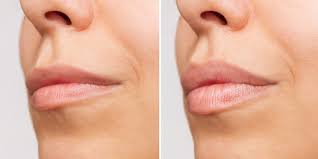 Your Lip Transformation Awaits: Hoboken’s Fillers