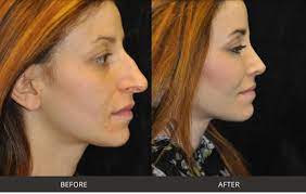 Achieve a Defined Jawline with Expert Fillers in Boston